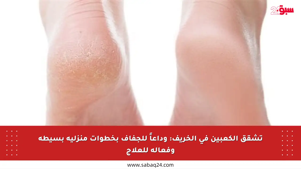 تشقق الكعبين في الخريف: وداعاً للجفاف بخطوات منزلية بسيطة وفعالة للعلاج